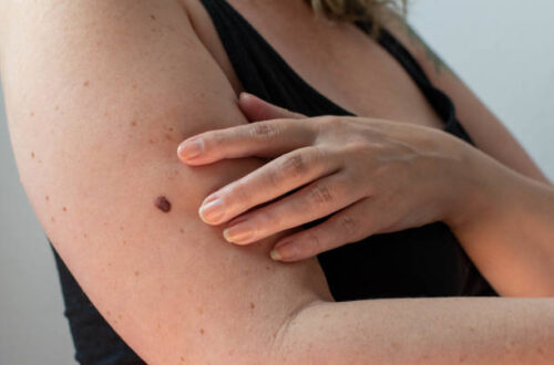 A Woman With A Concerning Mole On Her Arm Which Needs To Be Removed