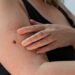 A Woman With A Concerning Mole On Her Arm Which Needs To Be Removed