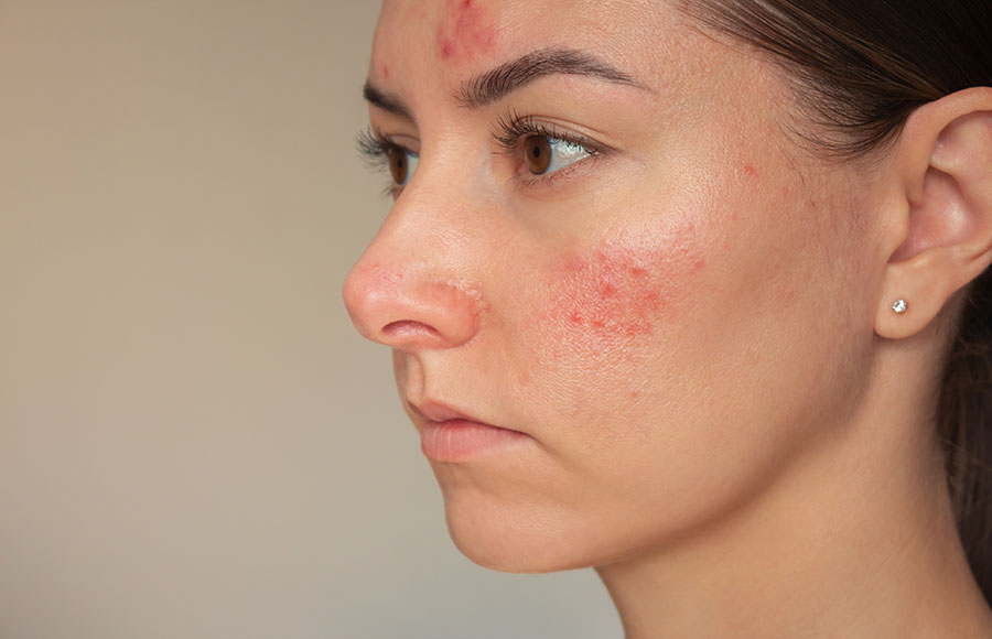 Young woman suffering from the skin chronic disease rosacea on her face in the acute stage.